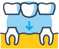 Dental Bridge 750 x750 pix 2