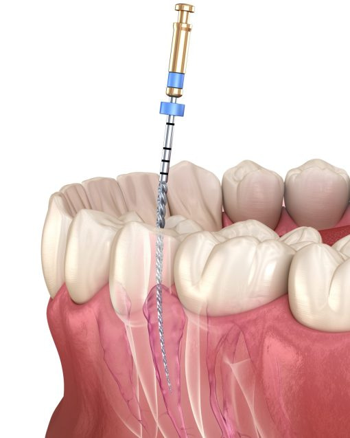 Endodontic root canal treatment process. Medically accurate tooth 3D illustration - Tandhälsan A6 Jönköping - Dentist in Jönköping